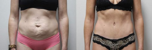 tummy tuck before and after photos by kryger institute of plastic surgery in thousand oaks ca