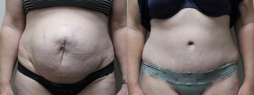 tummy tuck before and after photos by kryger institute of plastic surgery in thousand oaks ca