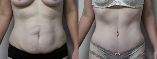 tummy tuck before and after photos by kryger institute of plastic surgery in thousand oaks ca