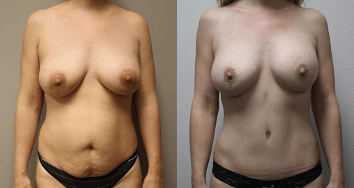 tummy tuck before and after photos by kryger institute of plastic surgery in thousand oaks ca