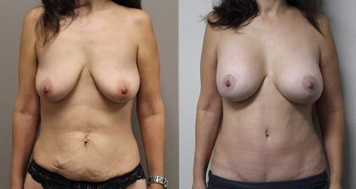 tummy tuck before and after photos by kryger institute of plastic surgery in thousand oaks ca