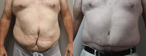 tummy tuck before and after photos by kryger institute of plastic surgery in thousand oaks ca