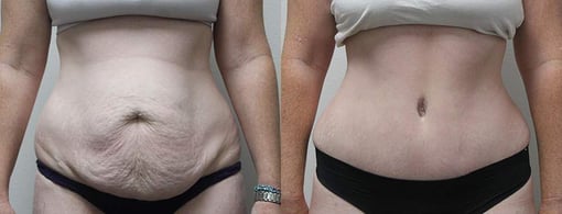 tummy tuck before and after photos by kryger institute of plastic surgery in thousand oaks ca