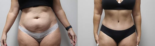 tummy tuck before and after photos by kryger institute of plastic surgery in thousand oaks ca