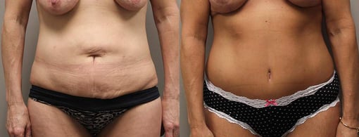 tummy tuck before and after photos by kryger institute of plastic surgery in thousand oaks ca