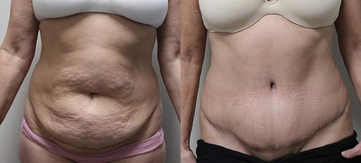 tummy tuck before and after photos by kryger institute of plastic surgery in thousand oaks ca