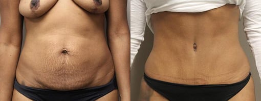 tummy tuck before and after photos by kryger institute of plastic surgery in thousand oaks ca