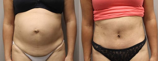 tummy tuck before and after photos by kryger institute of plastic surgery in thousand oaks ca