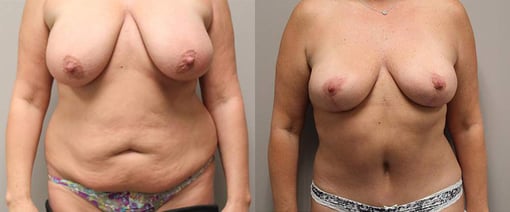tummy tuck before and after photos by kryger institute of plastic surgery in thousand oaks ca