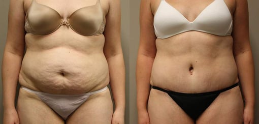 tummy tuck before and after photos by kryger institute of plastic surgery in thousand oaks ca