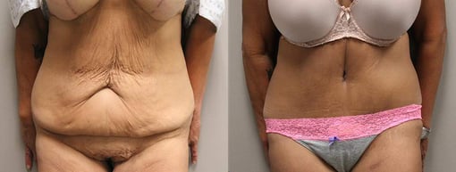 tummy tuck before and after photos by kryger institute of plastic surgery in thousand oaks ca