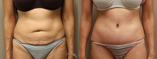 tummy tuck before and after photos by kryger institute of plastic surgery in thousand oaks ca