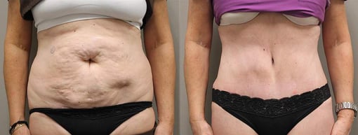 tummy tuck before and after photos by kryger institute of plastic surgery in thousand oaks ca