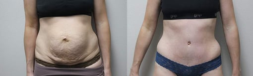 tummy tuck before and after photos by kryger institute of plastic surgery in thousand oaks ca