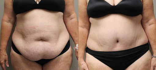 tummy tuck before and after photos by kryger institute of plastic surgery in thousand oaks ca