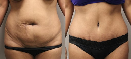 tummy tuck before and after photos by kryger institute of plastic surgery in thousand oaks ca