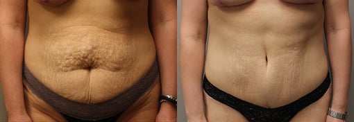tummy tuck before and after photos by kryger institute of plastic surgery in thousand oaks ca
