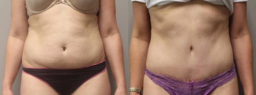 tummy tuck before and after photos by kryger institute of plastic surgery in thousand oaks ca
