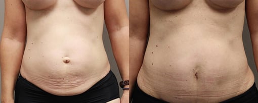 tummy tuck before and after photos by kryger institute of plastic surgery in thousand oaks ca
