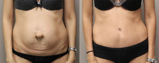 tummy tuck before and after photos by kryger institute of plastic surgery in thousand oaks ca