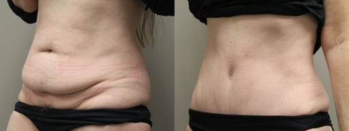 tummy tuck before and after photos by kryger institute of plastic surgery in thousand oaks ca