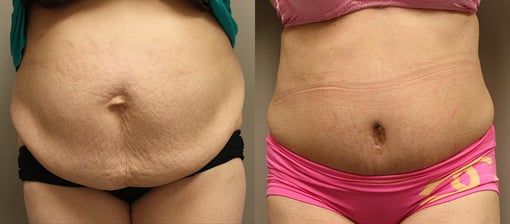 tummy tuck before and after photos by kryger institute of plastic surgery in thousand oaks ca