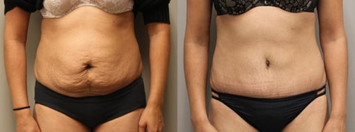 tummy tuck before and after photos by kryger institute of plastic surgery in thousand oaks ca