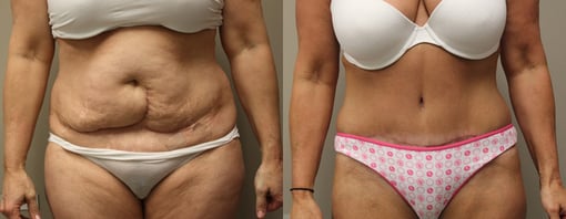 tummy tuck before and after photos by kryger institute of plastic surgery in thousand oaks ca
