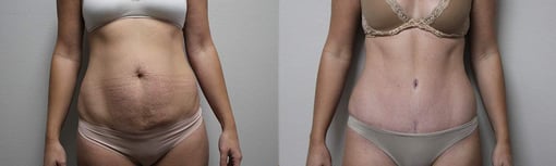 tummy tuck before and after photos by kryger institute of plastic surgery in thousand oaks ca