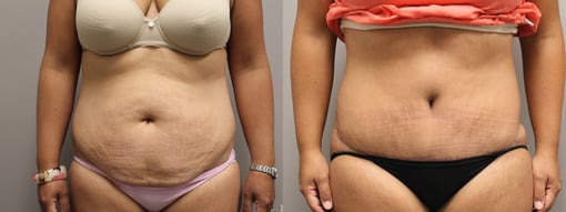 tummy tuck before and after photos by kryger institute of plastic surgery in thousand oaks ca