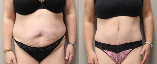 tummy tuck before and after photos by kryger institute of plastic surgery in thousand oaks ca
