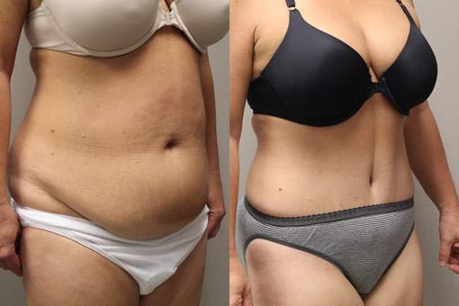 tummy tuck before and after photos by kryger institute of plastic surgery in thousand oaks ca