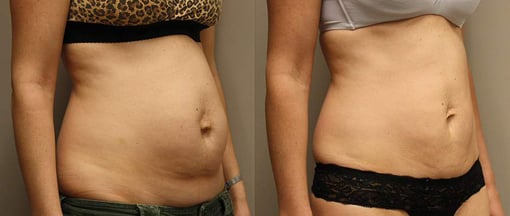 tummy tuck before and after photos by kryger institute of plastic surgery in thousand oaks ca