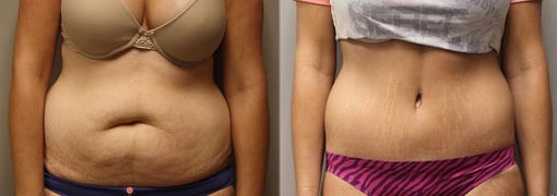 tummy tuck before and after photos by kryger institute of plastic surgery in thousand oaks ca