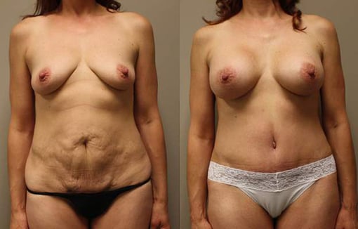 tummy tuck before and after photos by kryger institute of plastic surgery in thousand oaks ca
