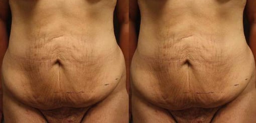 tummy tuck before and after photos by kryger institute of plastic surgery in thousand oaks ca