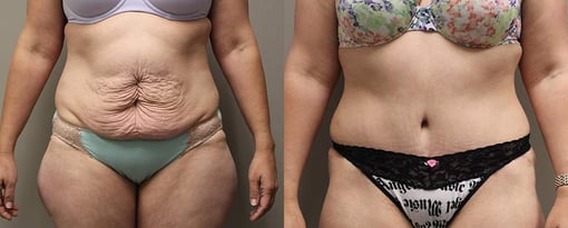 tummy tuck before and after photos by kryger institute of plastic surgery in thousand oaks ca
