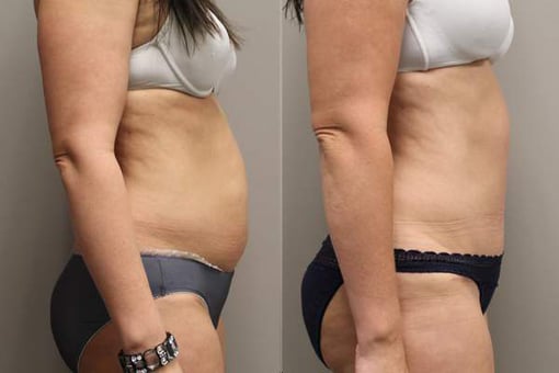 tummy tuck before and after photos by kryger institute of plastic surgery in thousand oaks ca