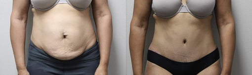 tummy tuck before and after photos by kryger institute of plastic surgery in thousand oaks ca