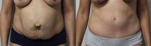 tummy tuck before and after photos by kryger institute of plastic surgery in thousand oaks ca