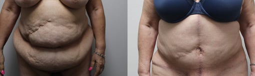 tummy tuck before and after photos by kryger institute of plastic surgery in thousand oaks ca