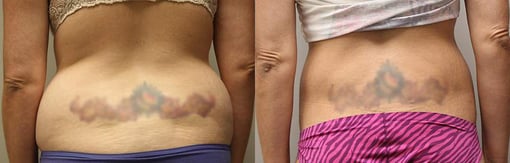 thigh and body lift before and after photos by kryger institute of plastic surgery in thousand oaks ca