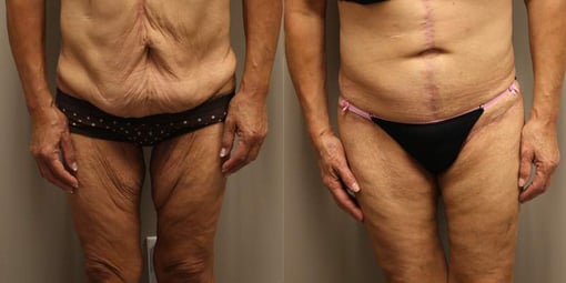 thigh and body lift before and after photos by kryger institute of plastic surgery in thousand oaks ca