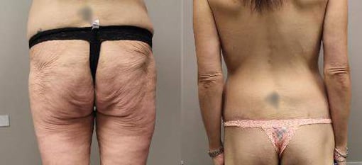 thigh and body lift before and after photos by kryger institute of plastic surgery in thousand oaks ca