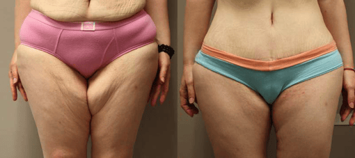 thigh and body lift before and after photos by kryger institute of plastic surgery in thousand oaks ca