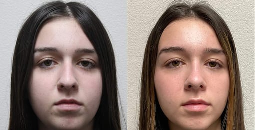 rhinoplasty before and after photos by kryger institute of plastic surgery in thousand oaks ca