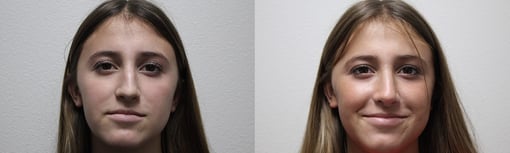 rhinoplasty before and after photos by kryger institute of plastic surgery in thousand oaks ca