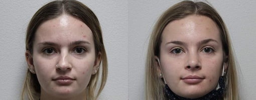 rhinoplasty before and after photos by kryger institute of plastic surgery in thousand oaks ca
