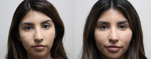 rhinoplasty before and after photos by kryger institute of plastic surgery in thousand oaks ca