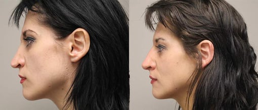 rhinoplasty before and after photos by kryger institute of plastic surgery in thousand oaks ca